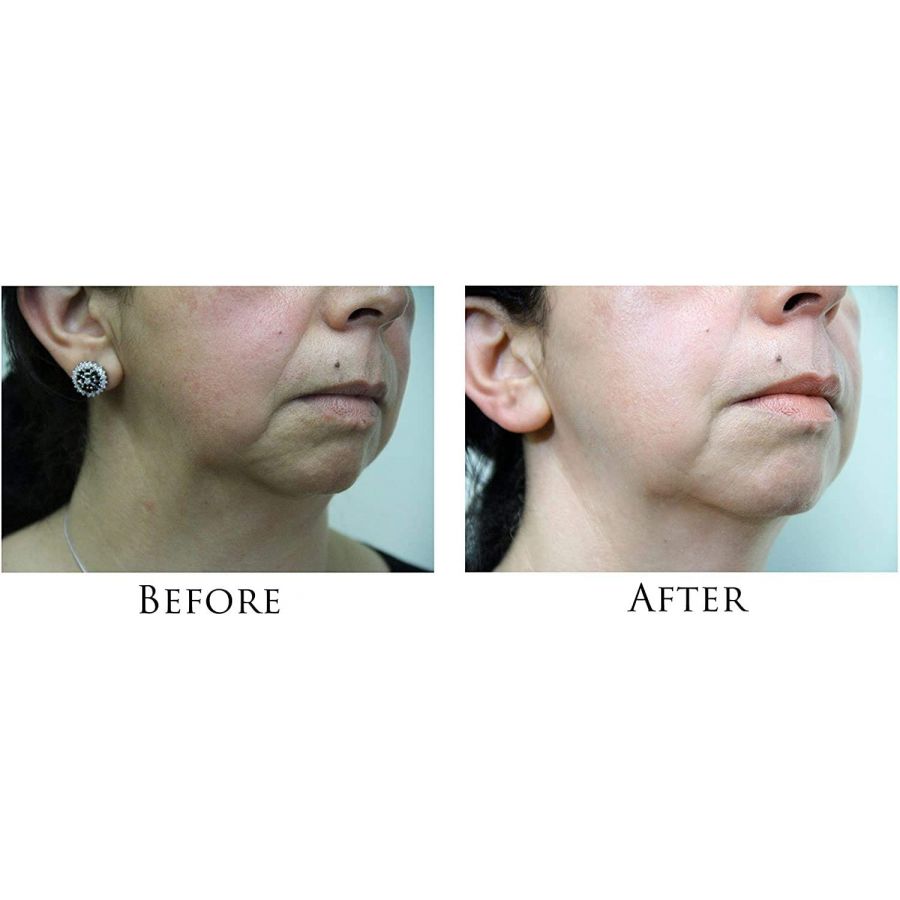 Wrinkle Reduction Facial Toning and Anti-Agin Microcurrent Machine